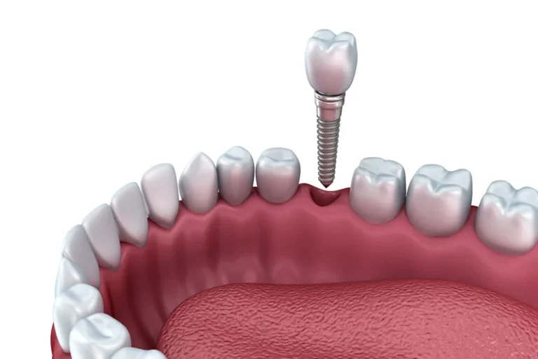 Why Choose Dental Implants To Replace Teeth?