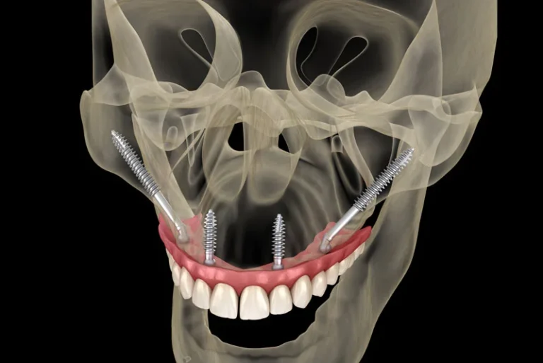 If I Have Severe Bone Loss Or Periodontal Disease, Can Zygomatic Implants In Yuba City, CA Restore My Smile?