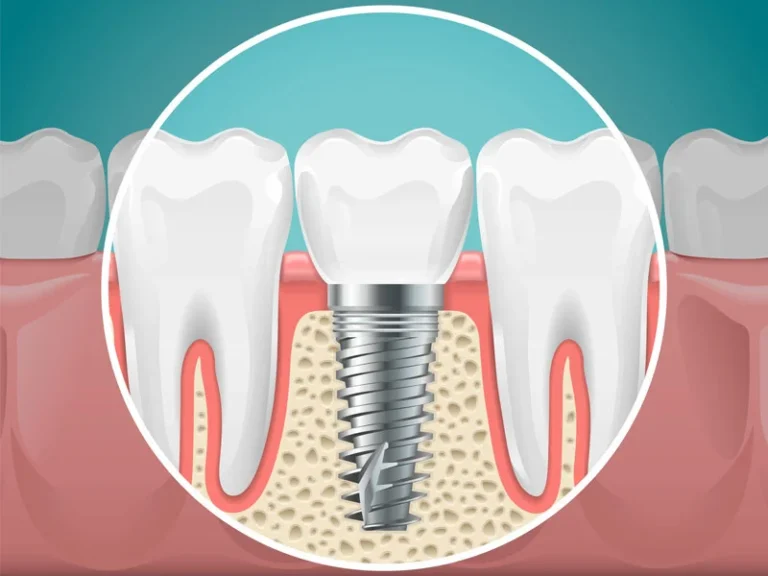 Do I Need A Temporary Prosthesis After My Full Mouth Dental Implants Are Placed?