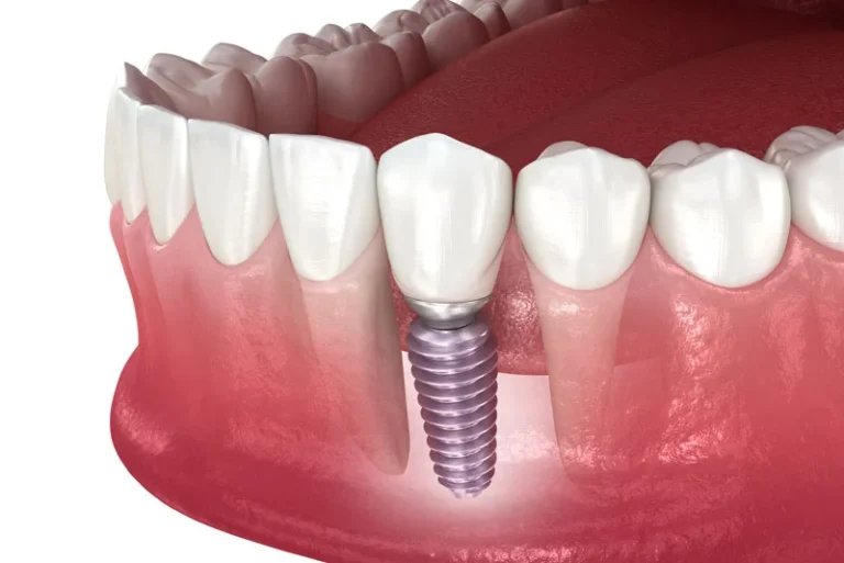 When I’m Getting My Dental Implants In Yuba City, CA Placed, What Does The Procedure Process Look Like?