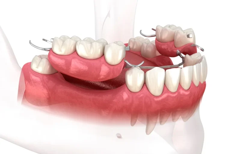 Is There A Difference Between A Temporary Prosthesis And A Final Prosthesis?