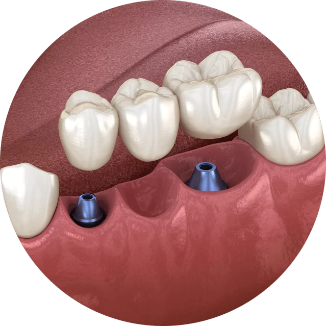 Graphic of implant supported bridge from Paramount Implant Center