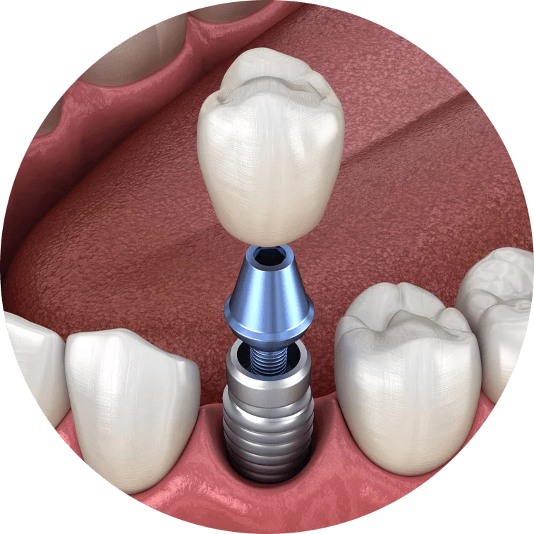 Graphic of single implants from Paramount Implant Center