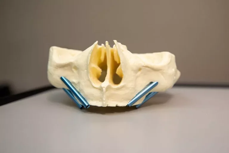 Zygomatic implants from Paramount Implant Center