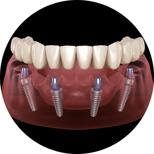 Graphic of full mouth dental implants from Paramount Implant Center