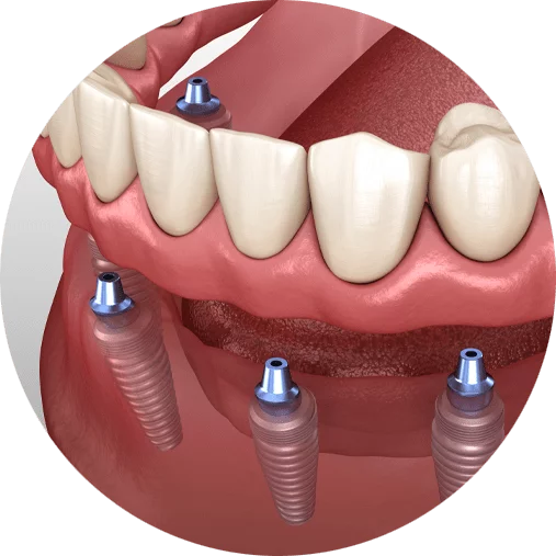 Graphic of implant supported dentures from Paramount Implant Center