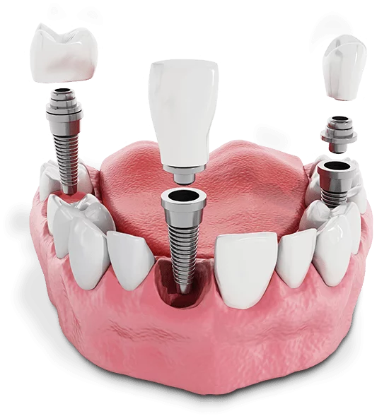 Graphic of how implant dentist services work from Paramount Implant Center