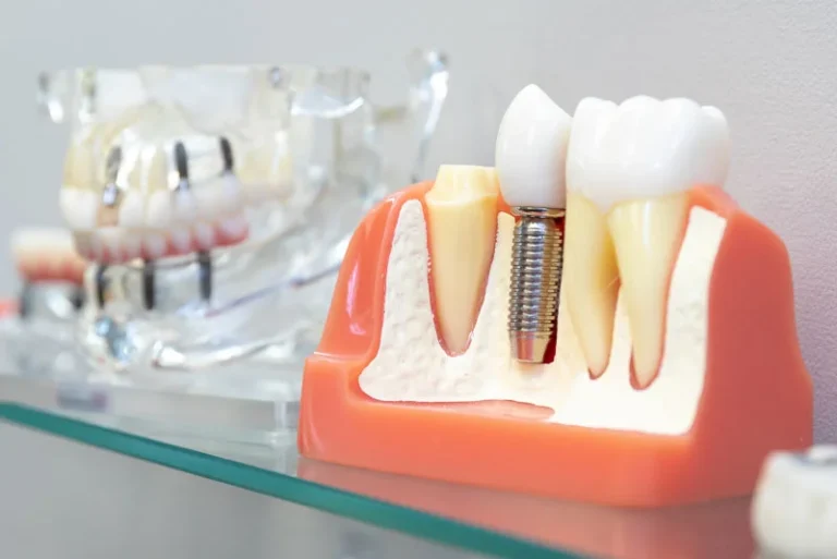 Wondering If Bone Grafting Is Necessary In Order To Get Treated With All-On-4® Dental Implants In Yuba City, CA? Here Is Why It Is Not