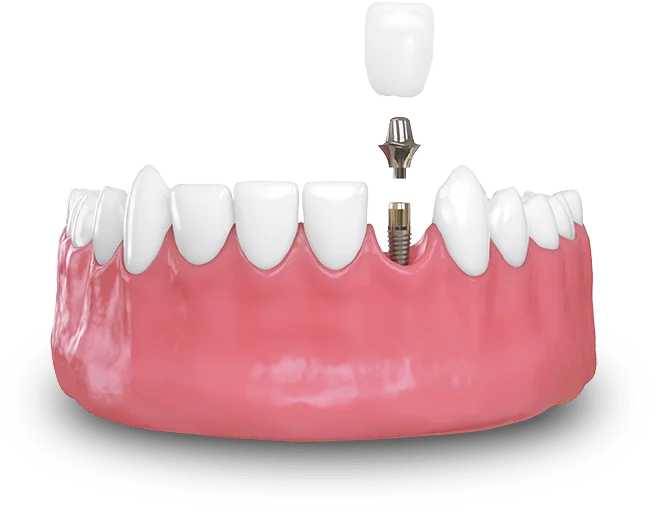 How Many Dental Implants Are Used For Full Mouth Dental Implants In Yuba City, CA?