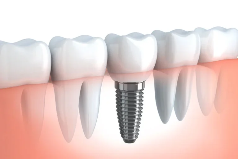 Wondering If You Can Become A Candidate For Dental Implants In Yuba City, CA? Here Is Who Can Become A Candidate For Dental Implants