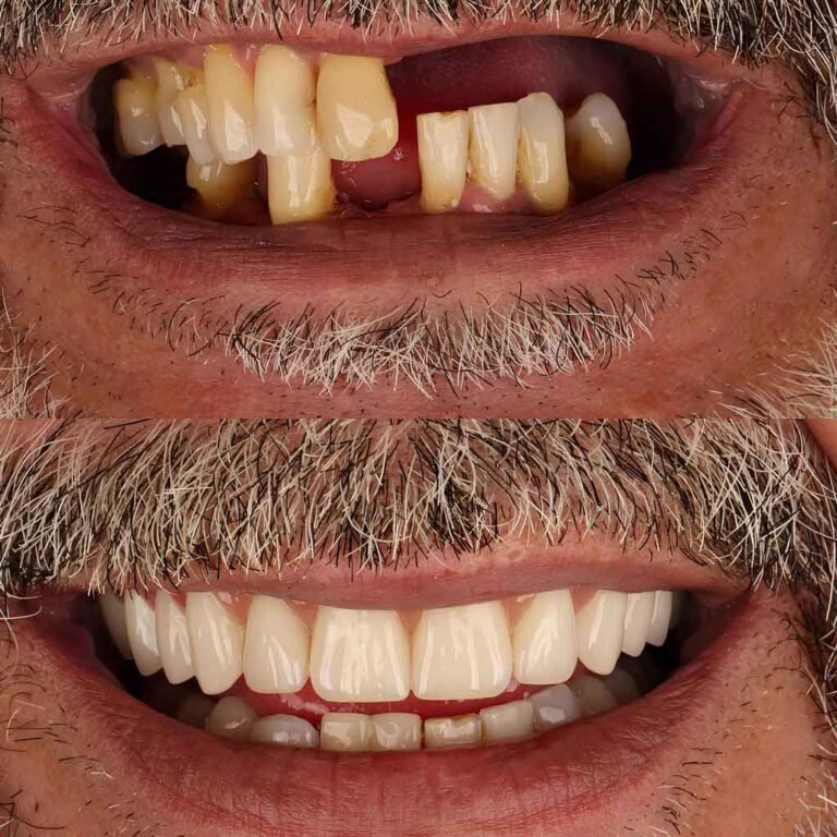 Before and after dental implants