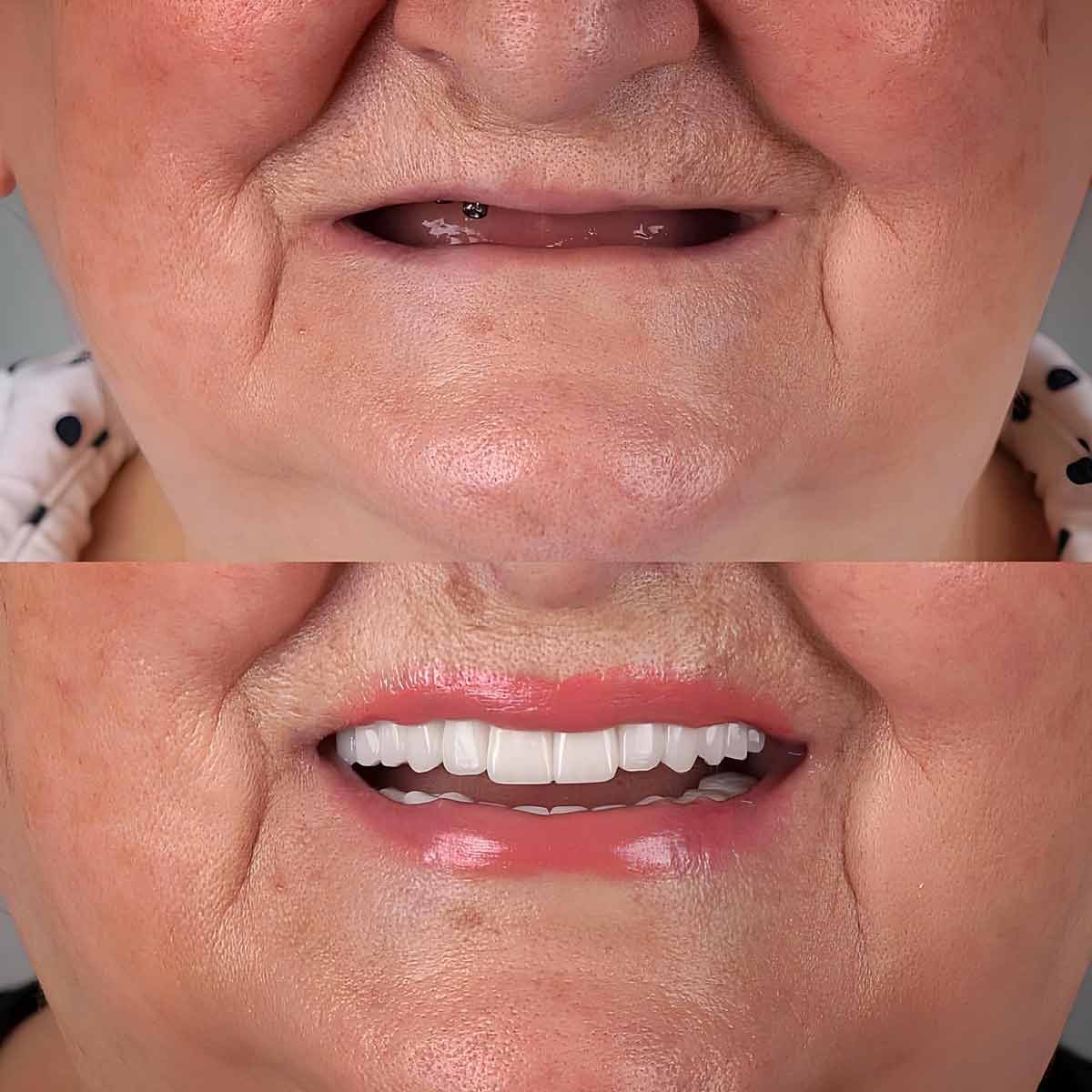 Before and after dental implants