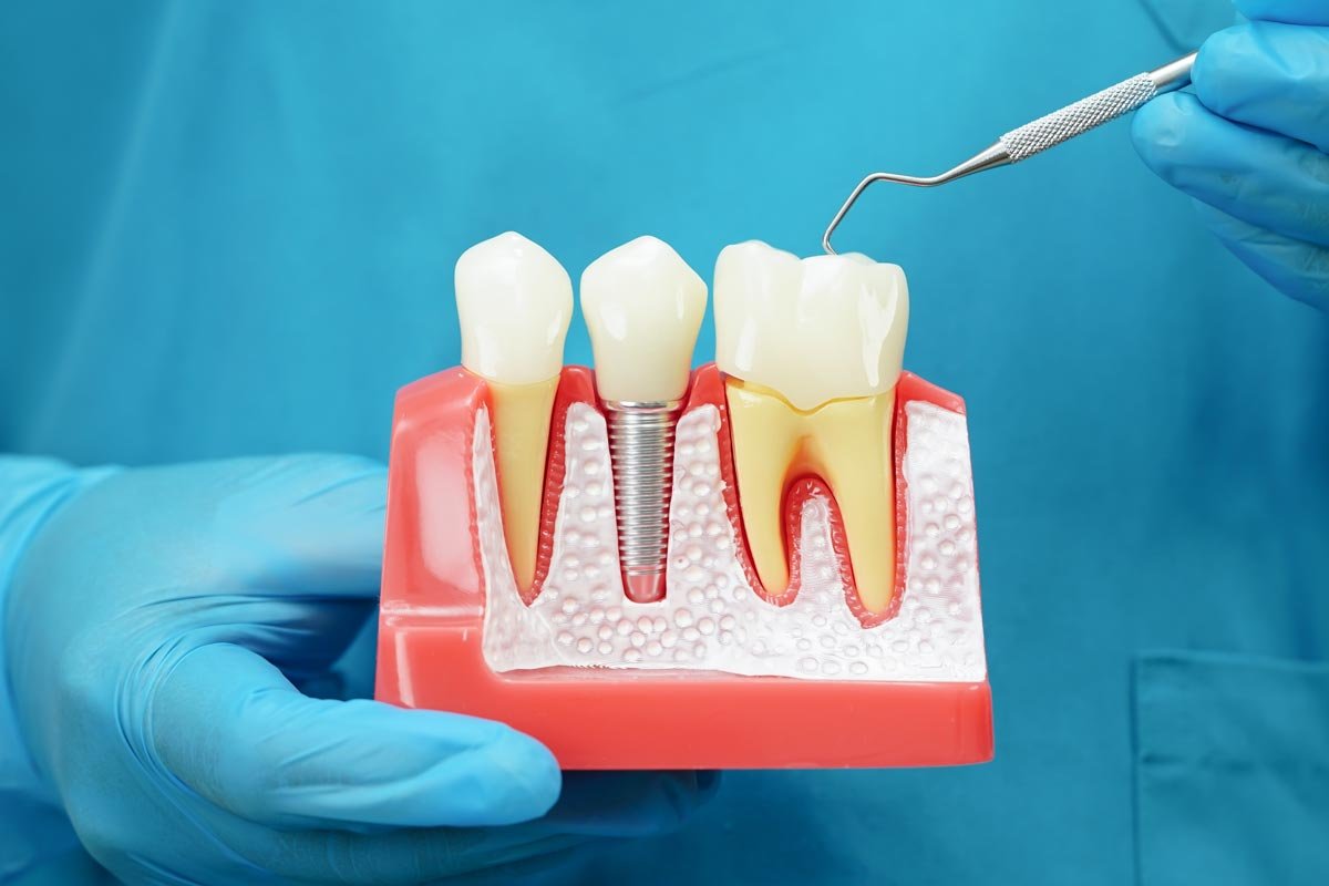 Dentist holding model with dental implant, artificial tooth roots into jaw 