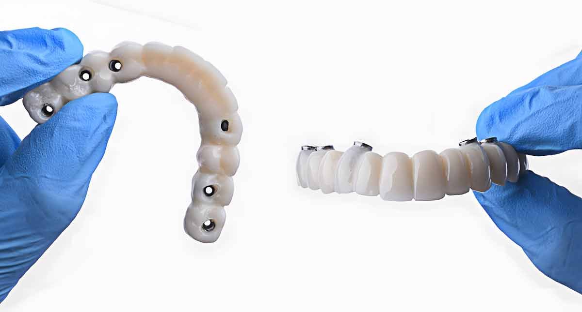 Full arch dental implants