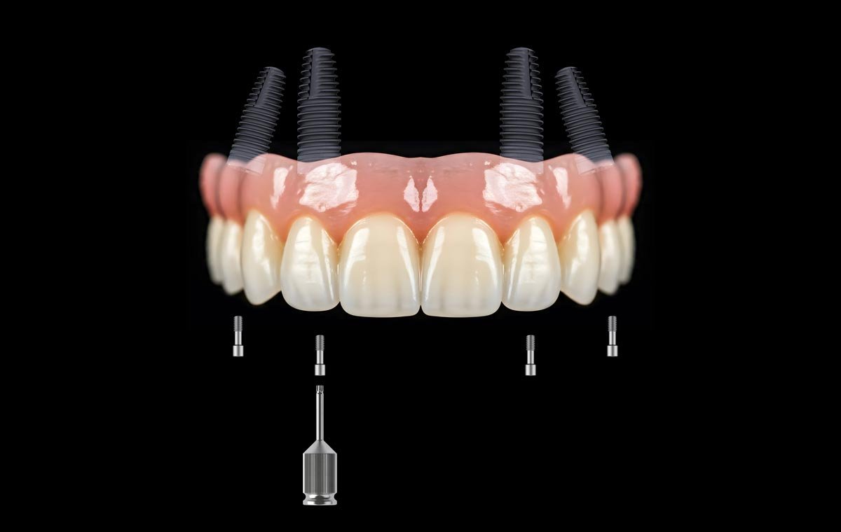 Image displaying how dental implants work