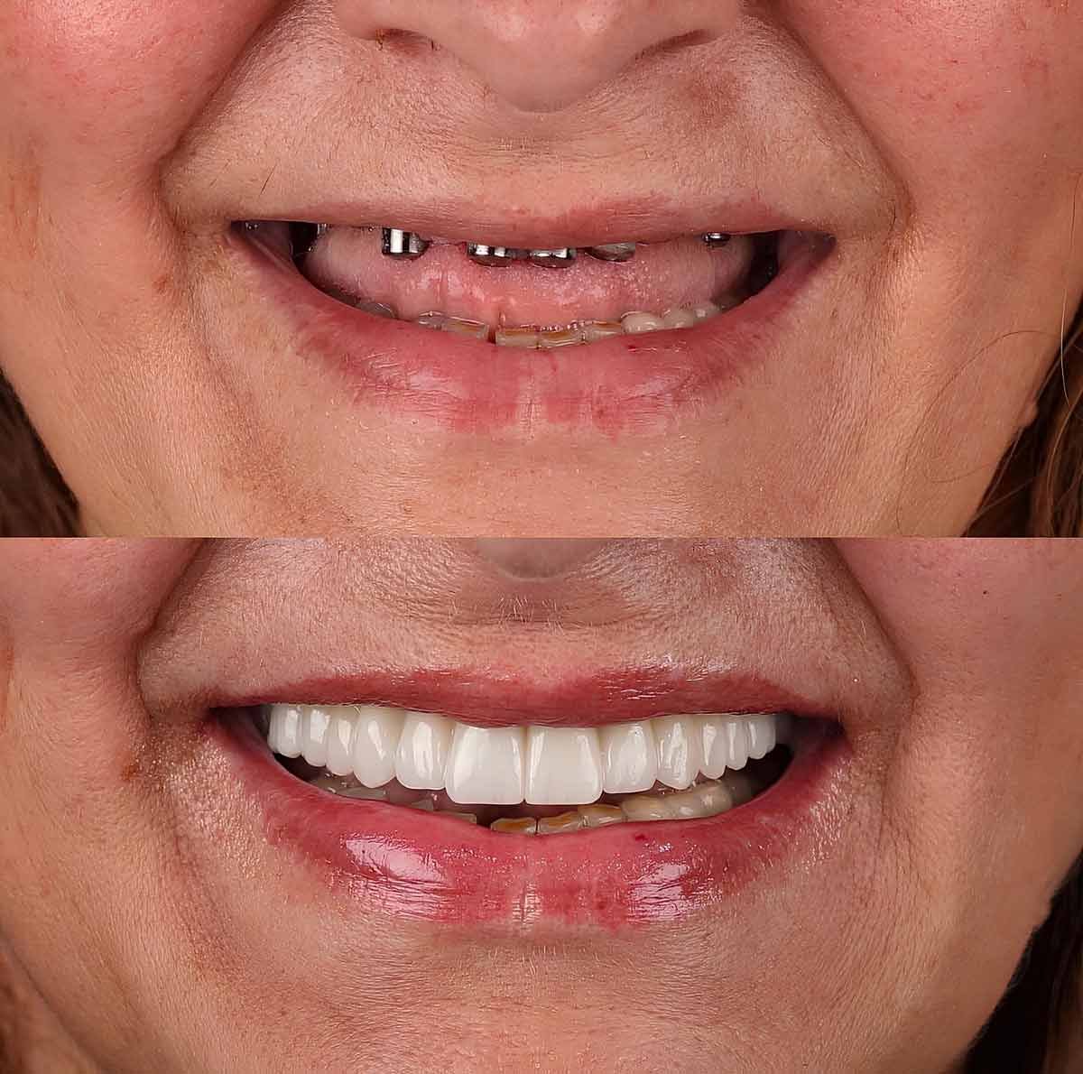 Picture showing the before and after of dental implants